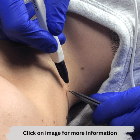 Epilation & Skin Blemish Removal ABT Diploma Package