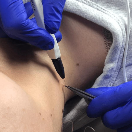 Epilation & Skin Blemish Removal ABT Diploma Package